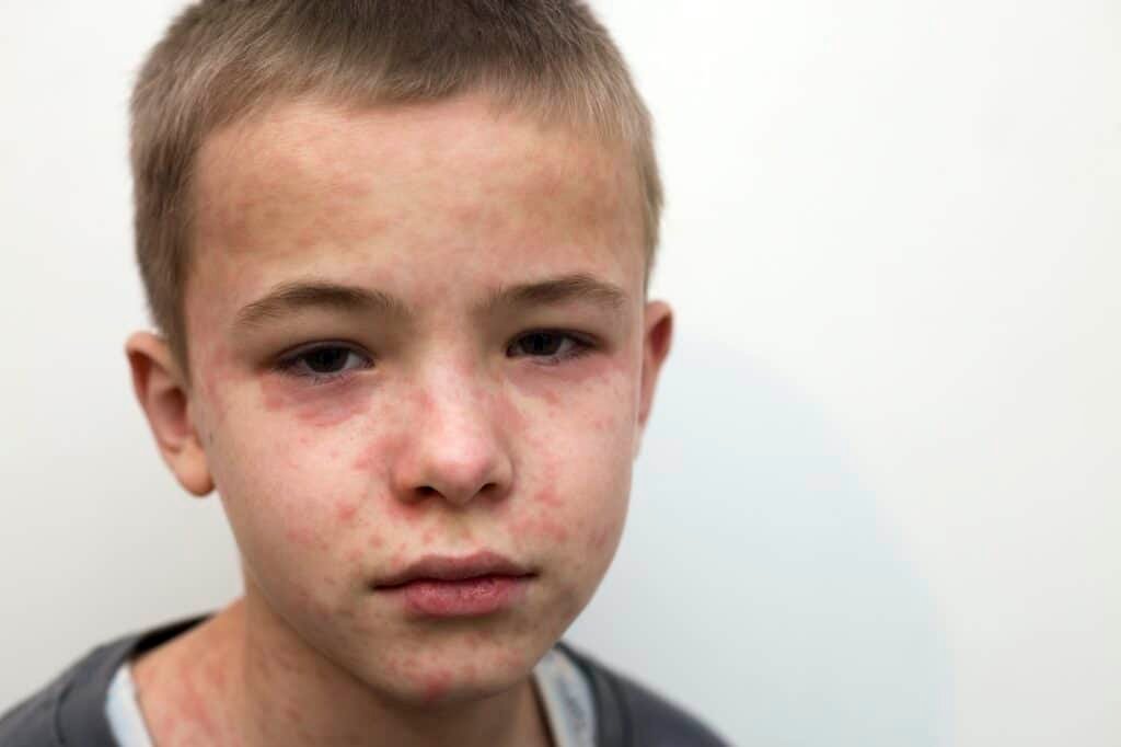 Portrait of sick sad boy child suffering from measles or chicken pox