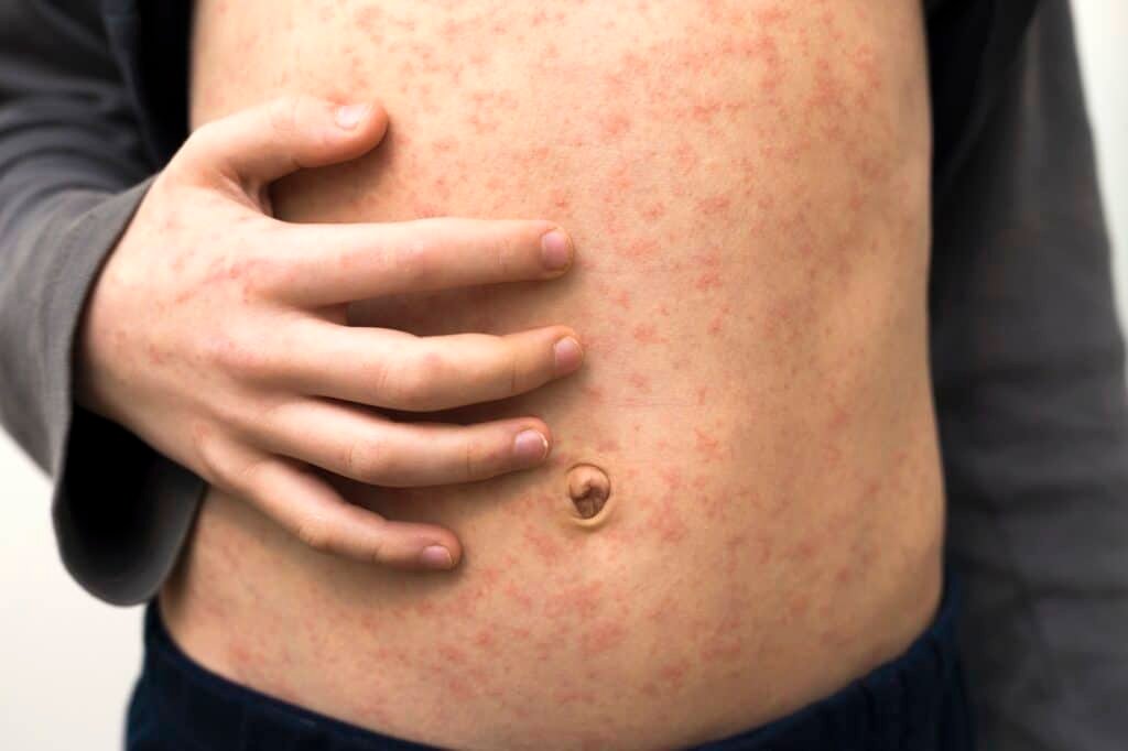 Sick child body, stomach with red rush spots from measles or chicken pox