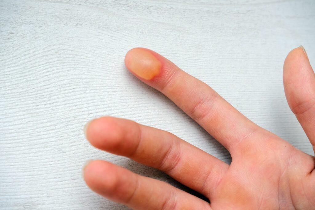 Isolated dirty injured hand with thermal burn on the finger. Inflamed bladder with fluid.