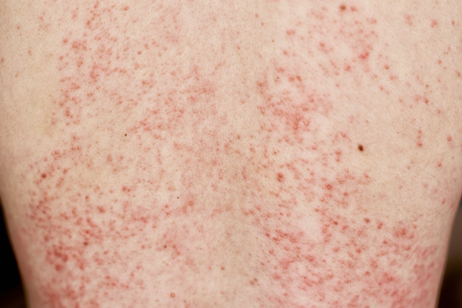 Allergisk utslett på huden. Kvinne med dermatologisk problem på rygghuden