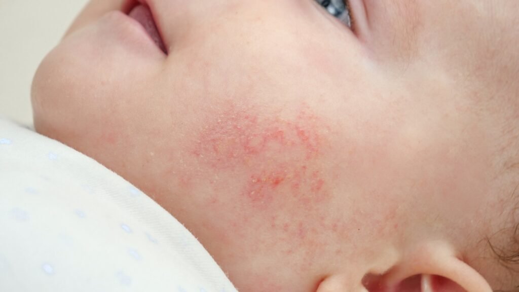 Nærbilde av babyansikt med rød hud som lider av akne og dermatitt. Konsept av nyfødt baby
