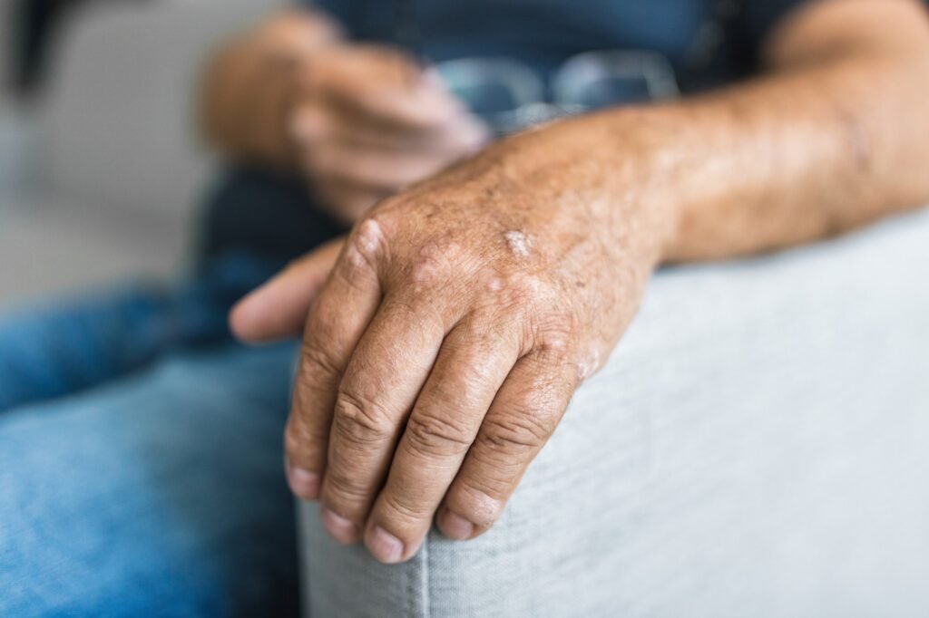 Eldre mann som lider av psoriasis på hendene