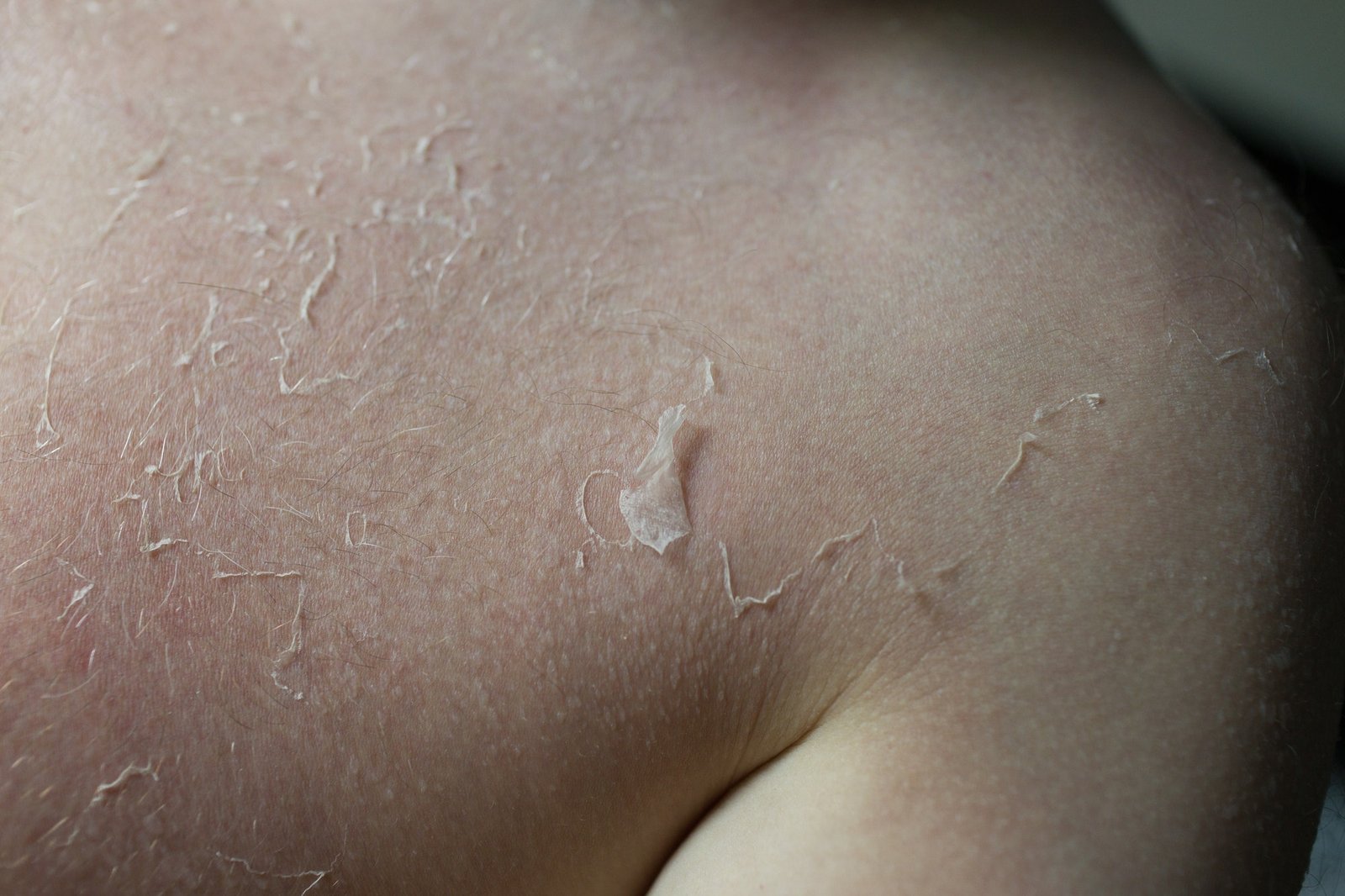 Man sunburn skin damage peeled off after exposure sun burn