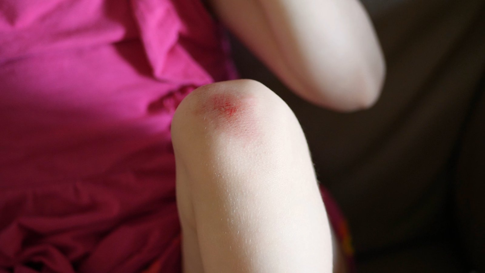 Wounded knee of the child, abrasions on the baby girl's knees.