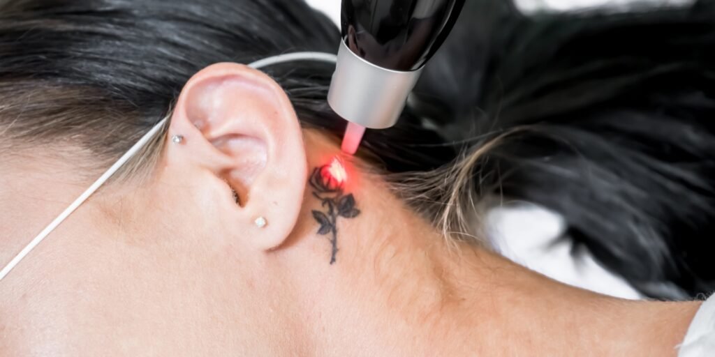 Bilde av en person som fjerner tatovering med laser.