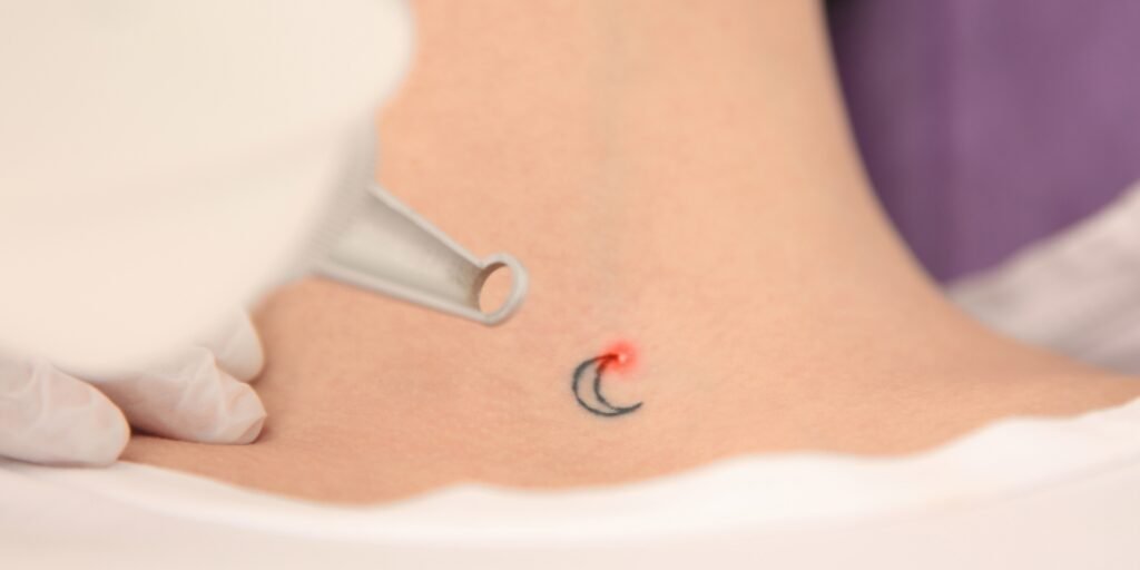 Fjerning av en måneformet tatovering med laser.