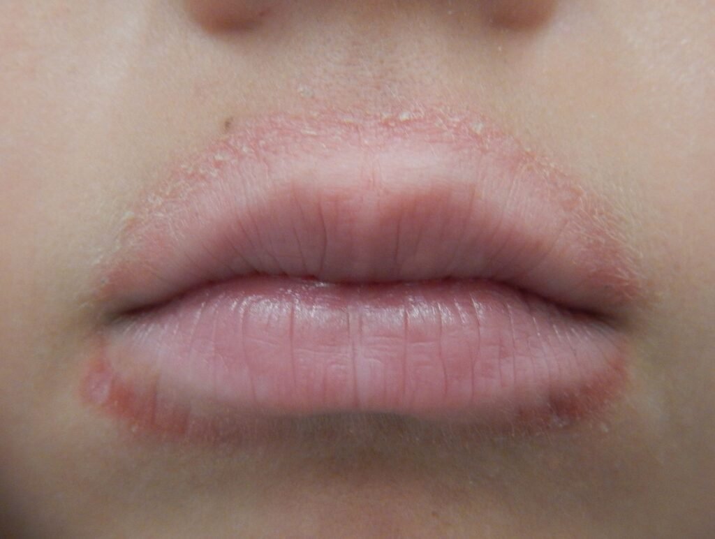 Perioral dermatitt på en yngre dame rundt munnen