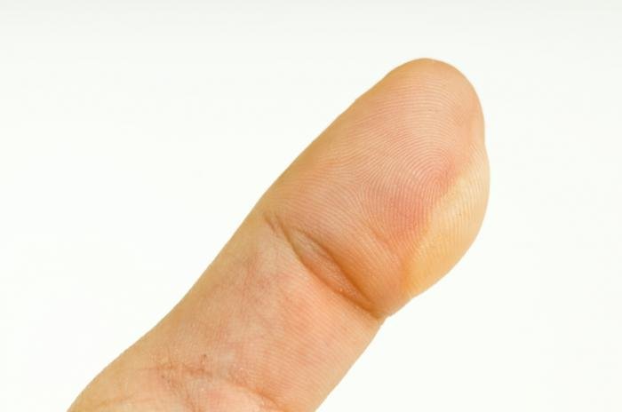 En blemme på fingeren