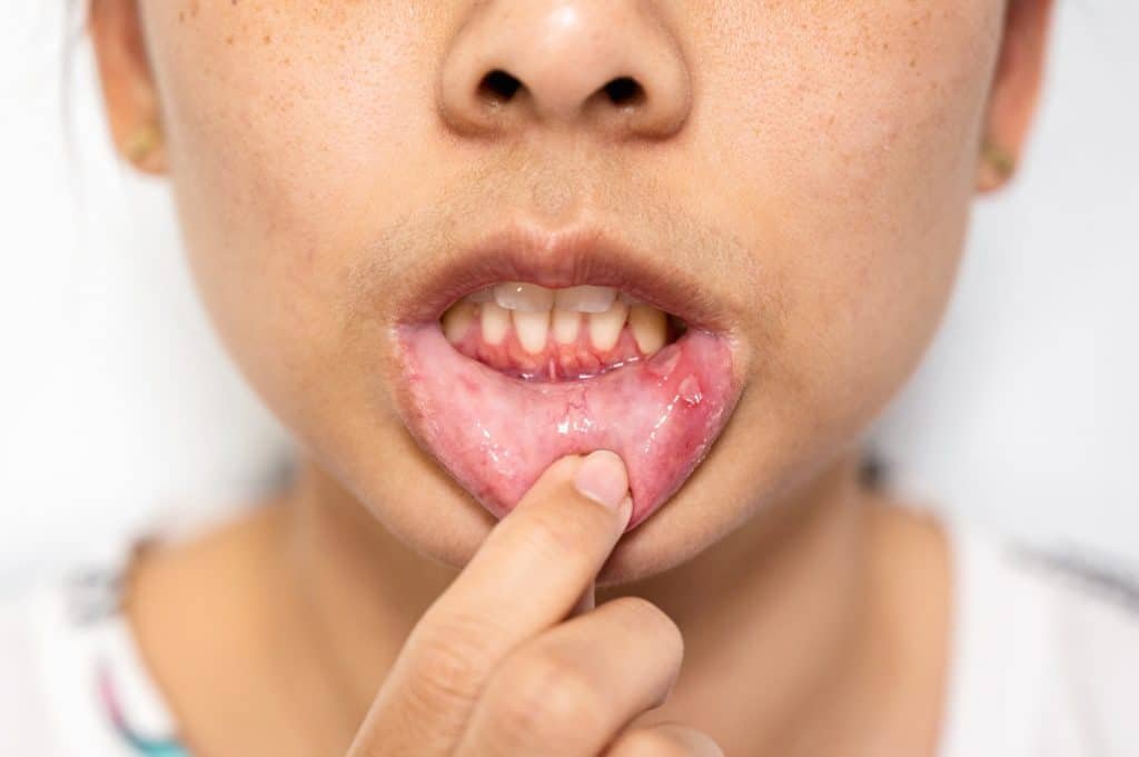 Asian woman have Aphthous ulcer or Canker sore on mouth at lip